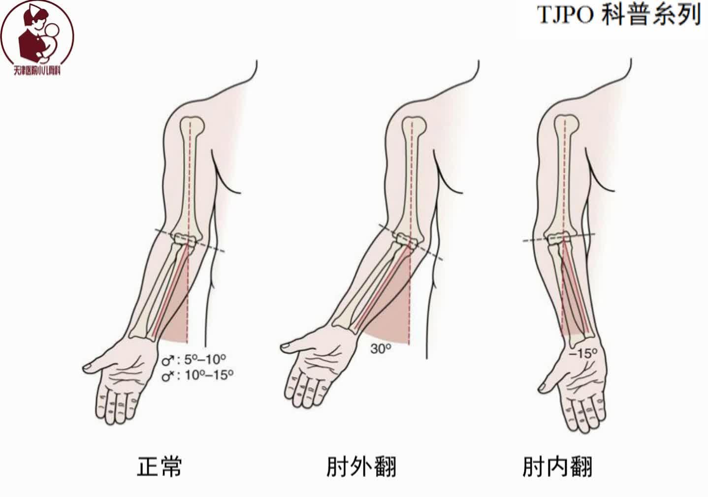 【文根四肢矫形科普系列】肘关节畸形怎么办？截骨矫形不置换 - 知乎